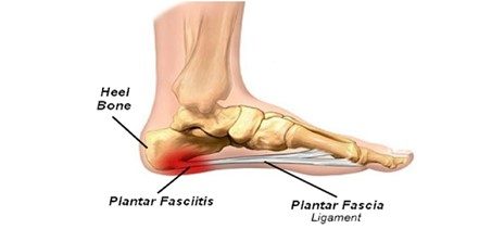 Anatomical diagram of the plantar fascia and the heel bone
