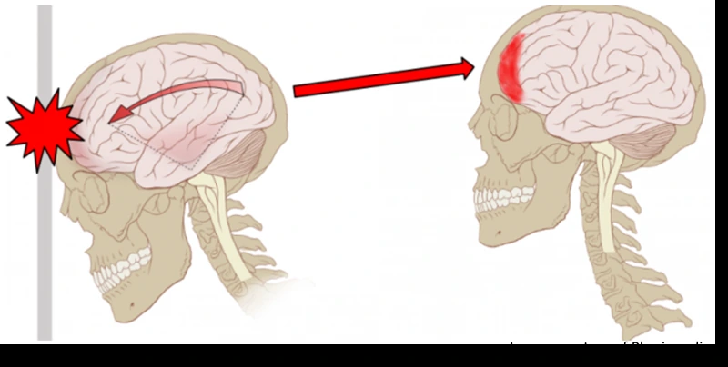 What Is a Concussion?