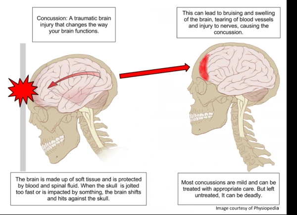 Diagram of how a concussion occurs inside the skull
