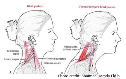 Illustration of text neck posture
