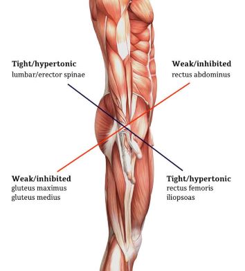 Diagram of lower crossed syndrome