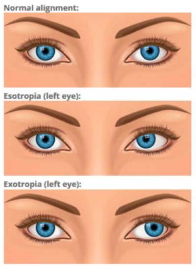 Diagram comparing normal eye alignment with esotropia and exotropia